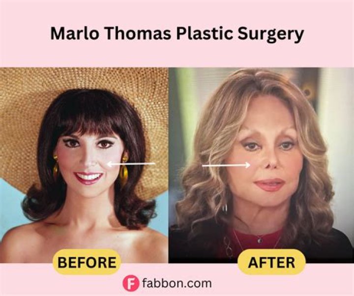Did Marlo Thomas Reshape Her Nose?