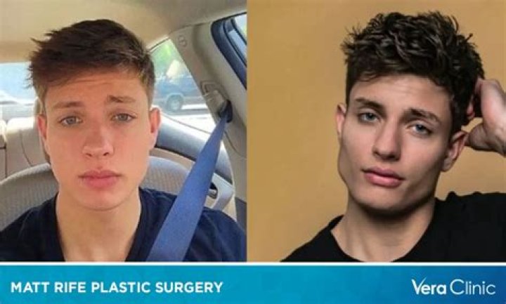 Matt Rife's Plastic Surgery Journey Explored