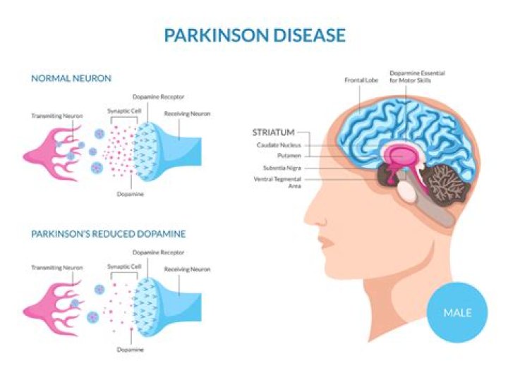Parkinson's Disease And Mark Levin