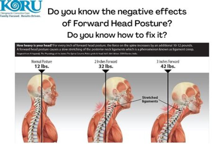 Uncovering The Truth Behind Forward Head Posture