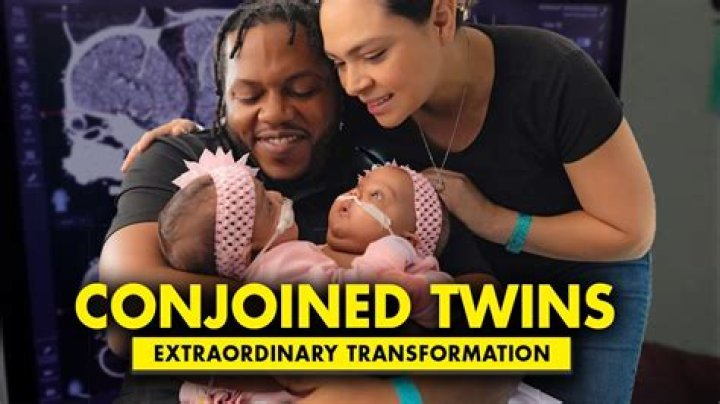 Unveiling The Extraordinary World Of Conjoined Twins: Discoveries And Insights